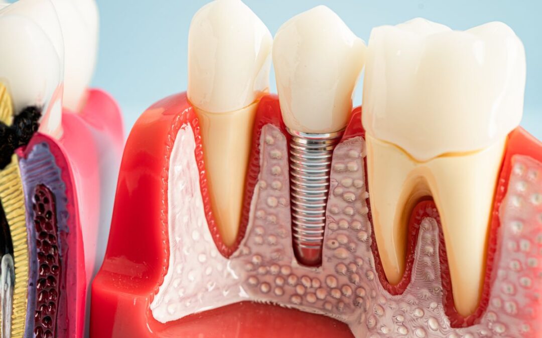 Why Dental Implants are the best Solution After Tooth Loss? The Benefits Explained