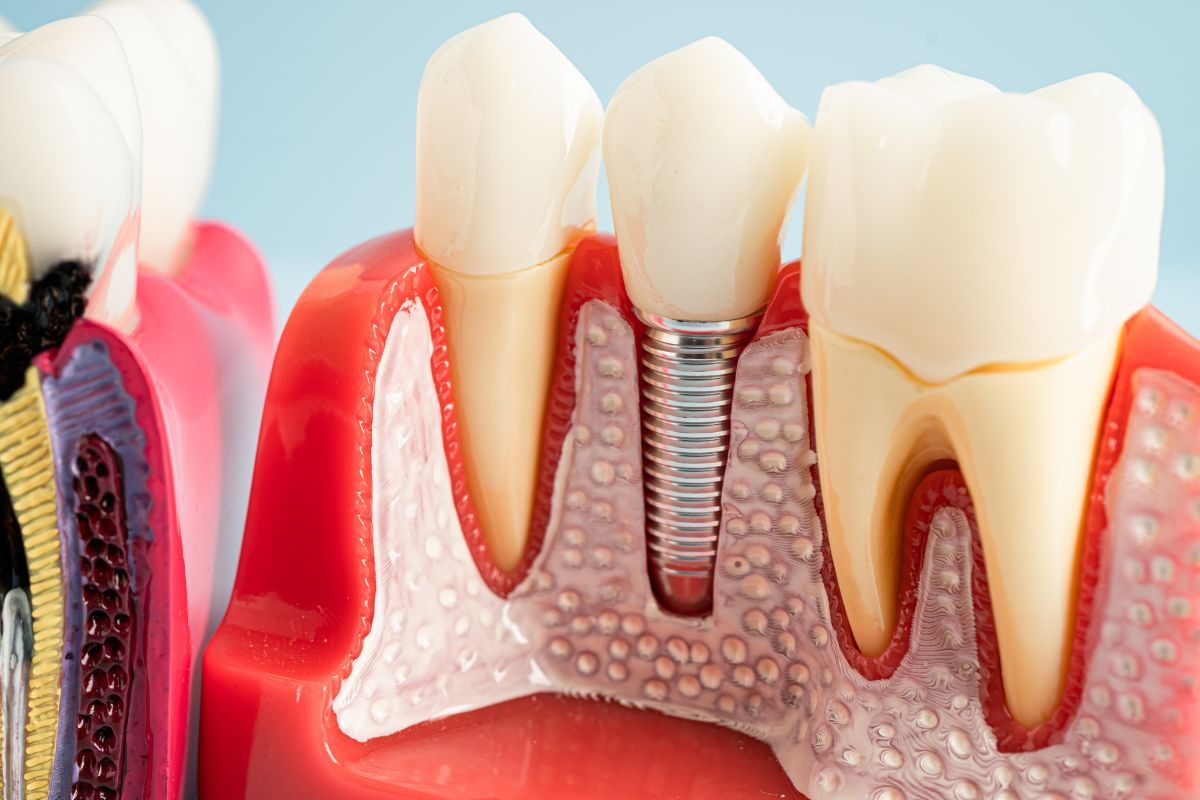 best-dental-implants-in-Phoenix