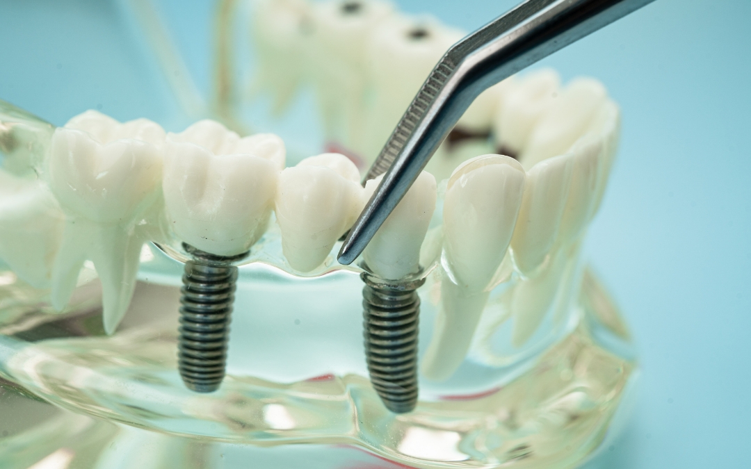 5 Immediate Actions to Take When a Dental Bridge Falls Out