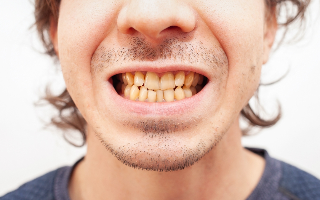 Can Yellow Teeth Become White Again?