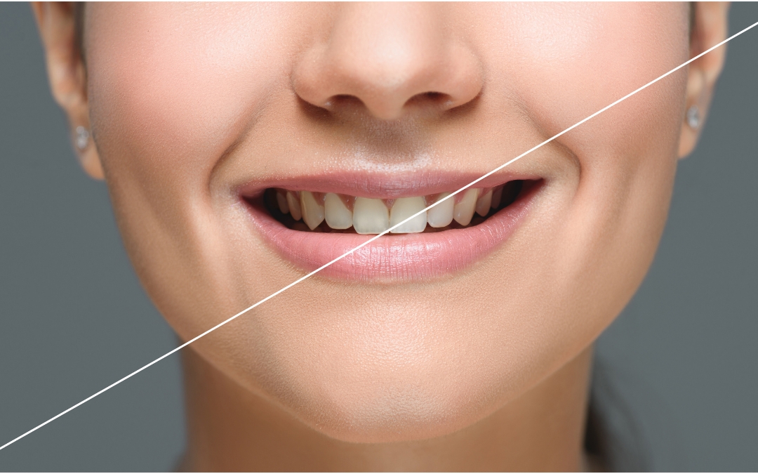 Homemade Teeth Whitening Solutions That Actually Work for Phoenix People