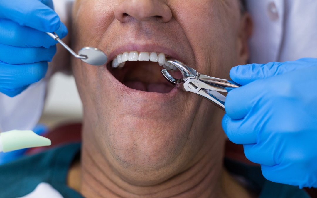 How Painful Is Tooth Extraction Without Anesthesia