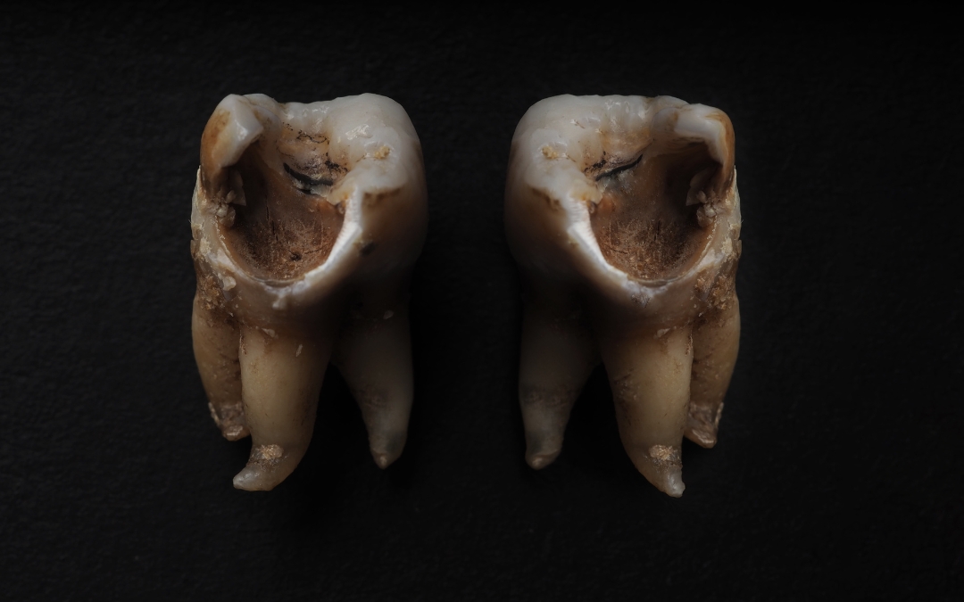 What to Do When a Decayed Tooth Falls Out?