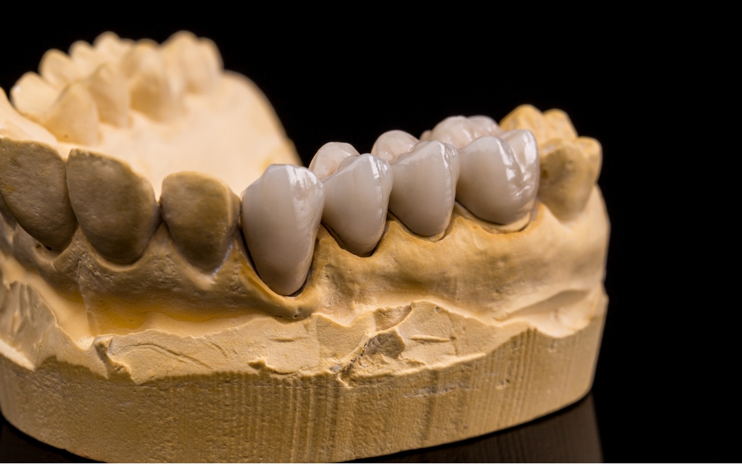 Can You Put a Dental Bridge After a Crown