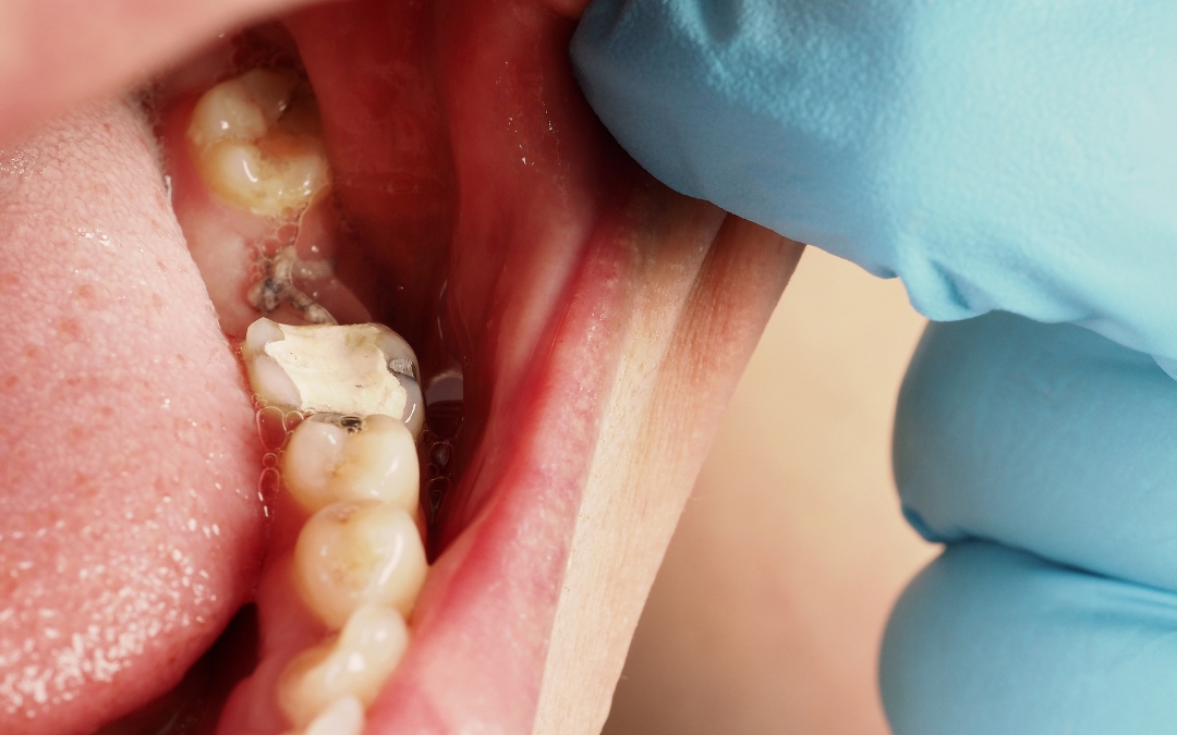 How Long Do Dental Stitches Take to Dissolve