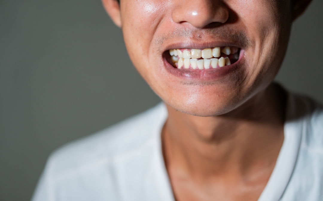 The Gap Between Your Dental Crown And Gums: How To Fix It?