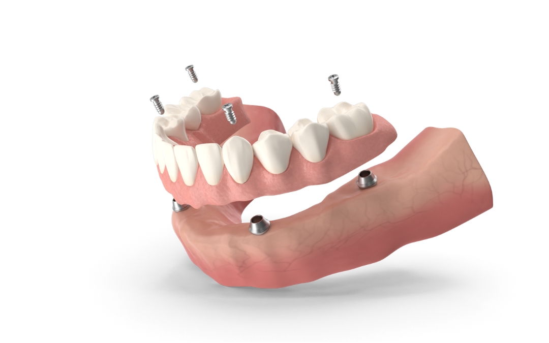 What to Do if You Experience Issues with Your All-on-4 Implants